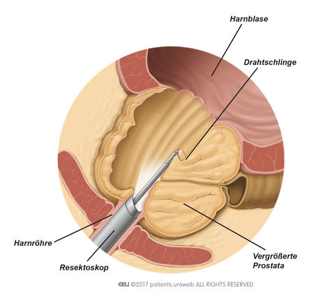 経尿道的前立腺切除術